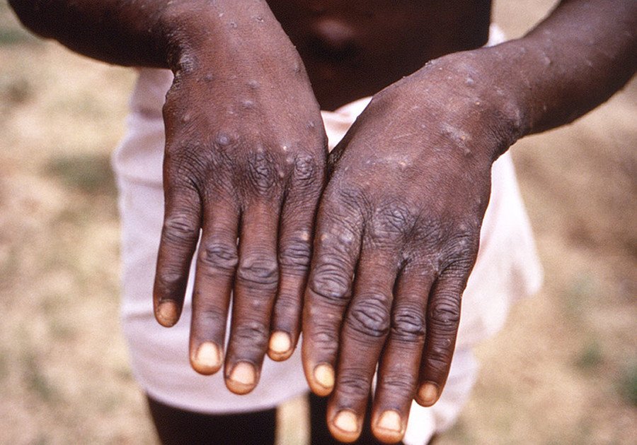 Aunque no es comparable con Covid-19, la Mpox requiere vigilancia global: OMS