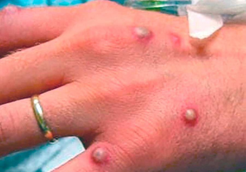 Descarta OMS pandemia de viruela s&iacute;mica