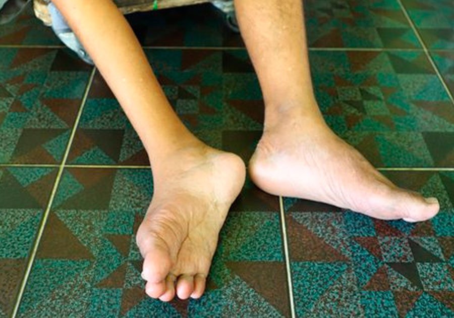 Detectan virus de la polio en aguas de las cloacas de Nueva York